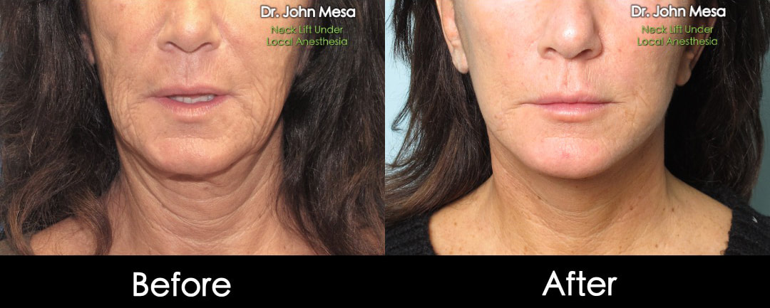 neck lift under local anesthesia before and after 
