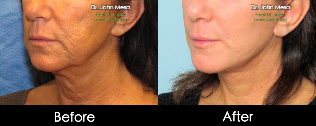 neck-lift-under-local-anesthesia-before-and-after