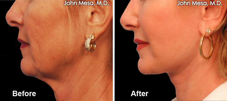 neck lift under local anesthesia before and after 