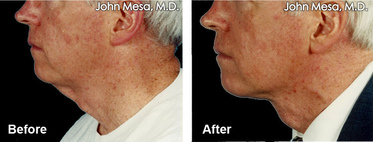 neck-lift-under-local-anesthesia-before-and-after